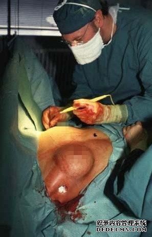 隆胸手术