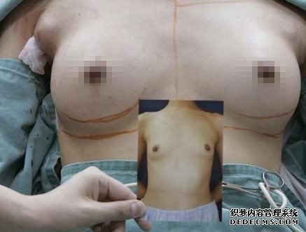 假体隆胸手术图