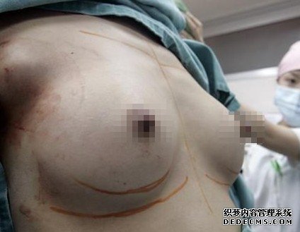 硅胶隆胸手术图
