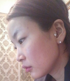 前颧骨磨骨