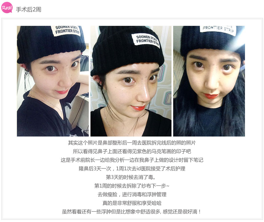 北京做综合隆鼻多少钱?哪家医院做的好?