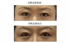 眼部整形失败修复一般要多少钱？