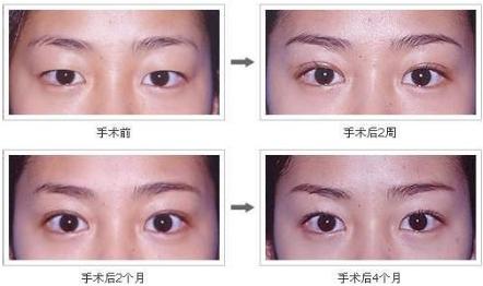 为什么要开眼角呢