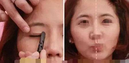 双眼皮贴造成眼皮松弛