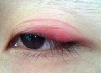眼皮发炎湿疹