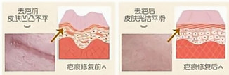 双眼皮术后祛疤