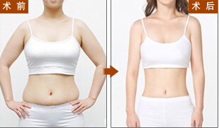 腹部吸脂减肥塑形对比图.jpg