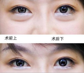 昆明怎样快速去眼袋