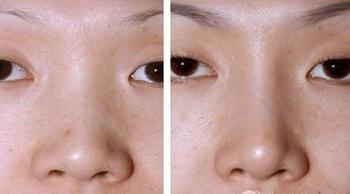 昆明艺星隆鼻整形吗?