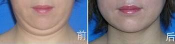 昆明吸脂去除双下巴要多少钱
