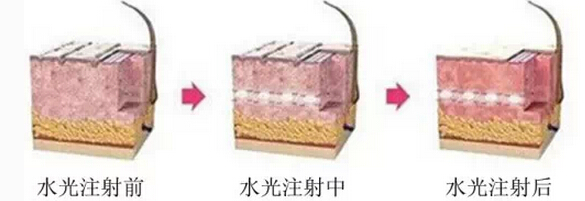 水光注射