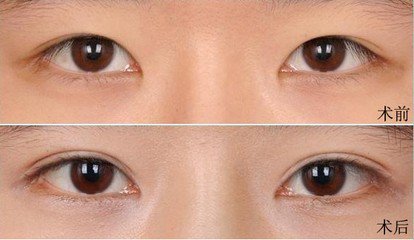 北京双眼皮修复手术 