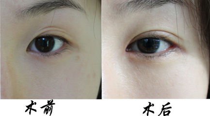 北京双眼皮修复手术