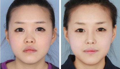 北京自体软骨鼻子修复手术