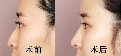 北京做假体隆鼻修复多少钱