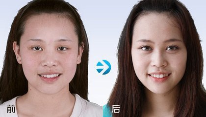 北京一般修复双眼皮多少钱