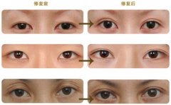 长沙眼部整形失败修复医院哪家好？