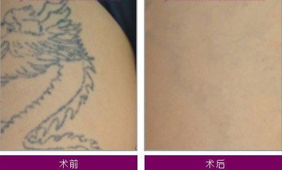 北京洗纹身正确方法有哪些