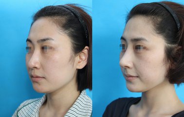 北京手术隆鼻失败修复