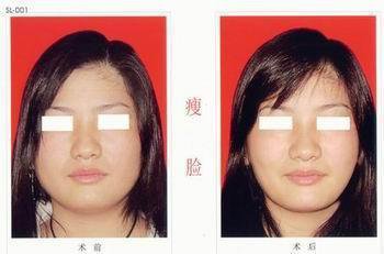 北京脸部吸脂手术是怎样做的