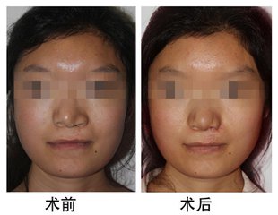 北京鼻小柱缺损修复