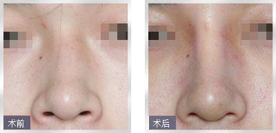 北京鼻子失败修复专家