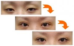 重庆做眼部吸脂需要多少钱？