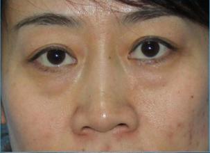 北京祛眼袋手术多少钱