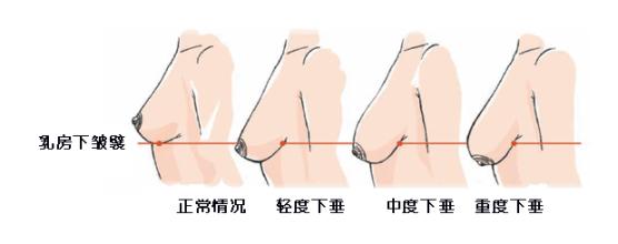 北京乳房下垂矫正手术价格?