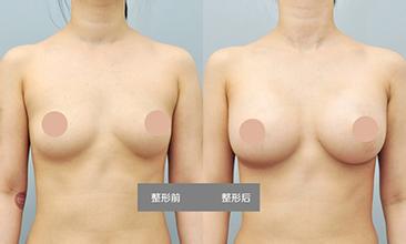 北京乳房下垂纠正手术会留疤吗