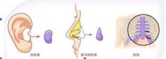 三亚自体软骨移植隆鼻医院哪家好