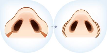 北京鼻翼整形的几种情况