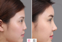 甘肃兰州哪家医院隆鼻好？