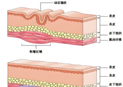 聚拉提后会加速衰老吗？聚焦超声提升实力盘点