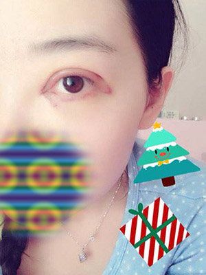 做了开眼角和全切 如何呢？