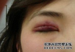 做韩式双眼皮加开眼角真的可以眼睛变大吗？
