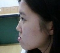 双颚手术后记(*^__^*) 嘻嘻……