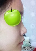 硅胶隆鼻真实案例图好看了吗？