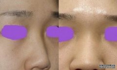 假体隆鼻【图片】好看了吗？