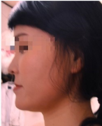 下颚前凸整形手术好看了吗？