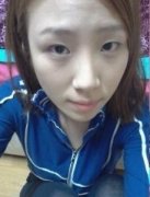北京丽都医疗美容医院做割双眼皮+吸脂术祛眼袋