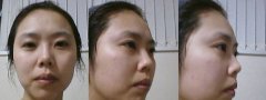 【做下颌骨】之后，看看我的变化，大家觉得怎