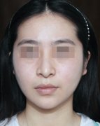 同大家分享一下我的隆鼻前后效果，大家看看肿