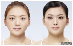 西安西京整形医院做全切双眼皮怎么样？