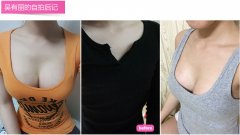 北京做水滴隆胸多少钱？哪家医院好？