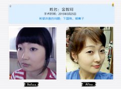 2015年3月份做了下颌角和综合隆鼻。