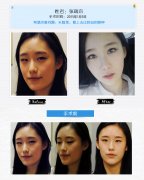 北京双鄂手术＋双眼皮手术开眼角多少钱？