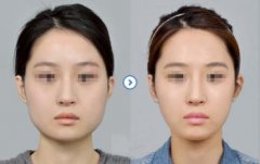 中日友好医院高占巍做磨骨技术怎么样？