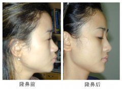 北京八大处李战强做隆鼻多少钱?