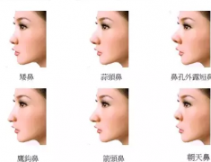 北京煤炭总院赵作钧做综合隆鼻怎么样